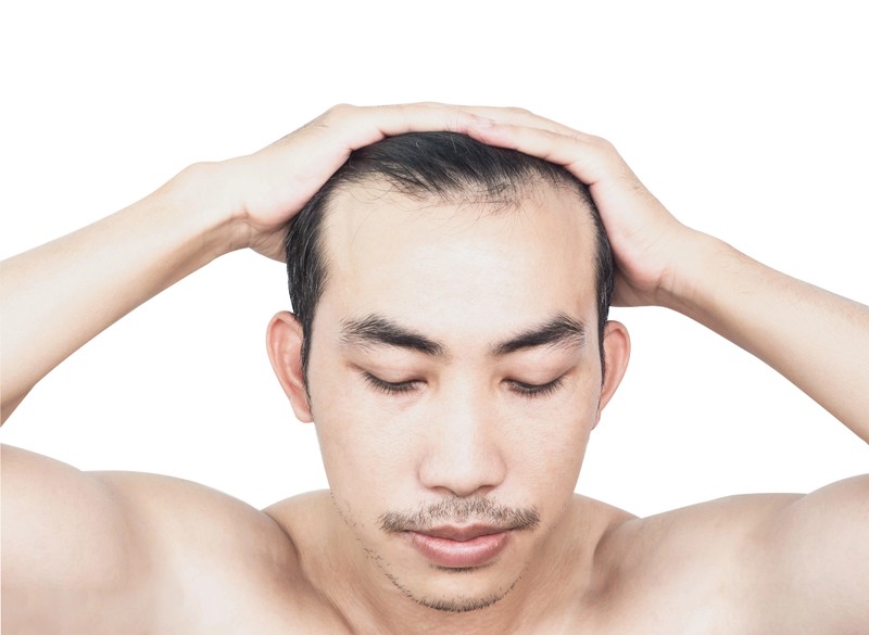 60 bis 80 % aller Männer leiden unter Haarausfall und Geheimratsecken.