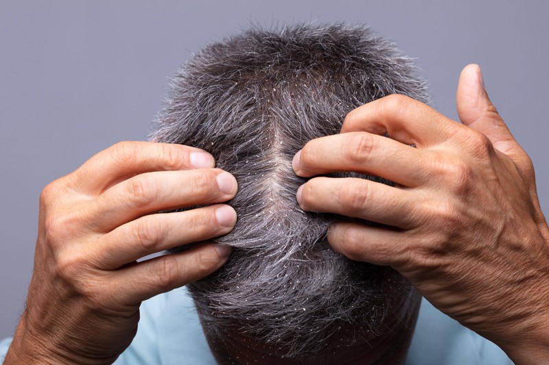 Viele Männer vergessen, dass auch die Kopfhaut Pflege braucht
