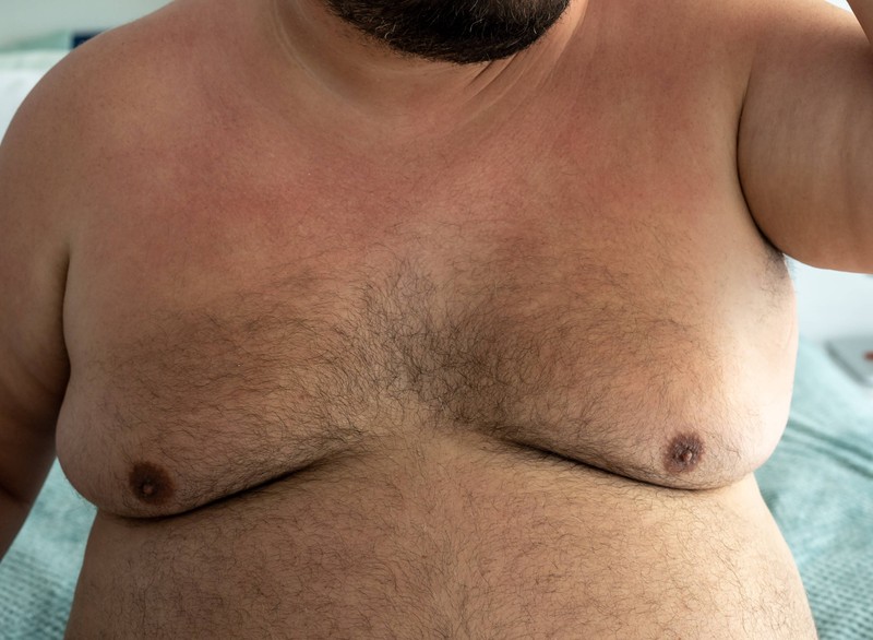 Eine Vergrößerung der Brustdrüsen, auch Gynäkomastie genannt, kann für Männer besonders belastend sein.
