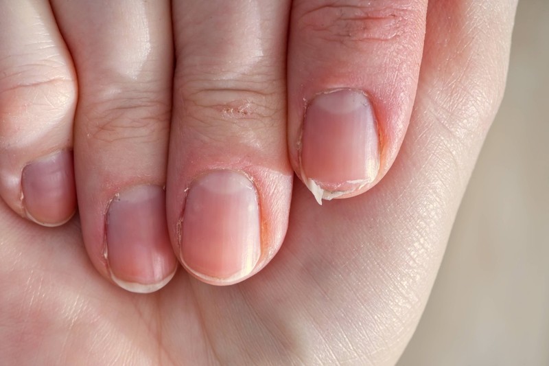 Brüchige Fingernägel können ein Indiz für Eisenmangel sein.