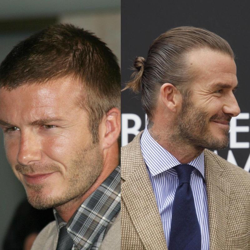Auch um David Beckham gibt es Gerüchte aufgrund einer Haartransplantation.