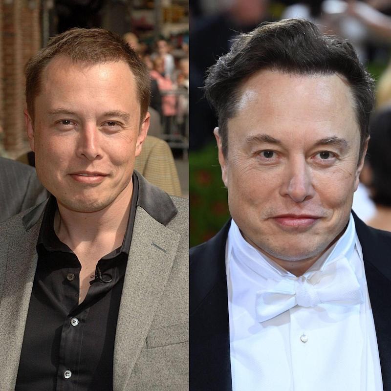 Elon Musk hat sich einer Haartransplantation unterzogen.