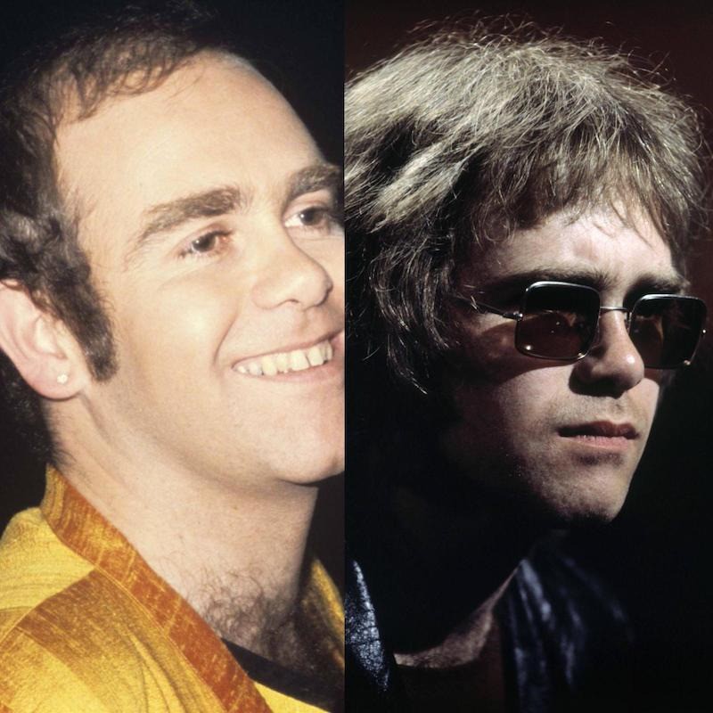 Elton John war ein Pionier im Bereich Haartransplantationen.